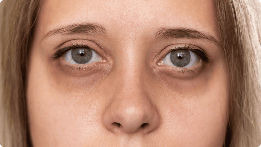 Cernes bleus, marron, creux – solutions patchs yeux Just Patch It pour chaque type de cerne